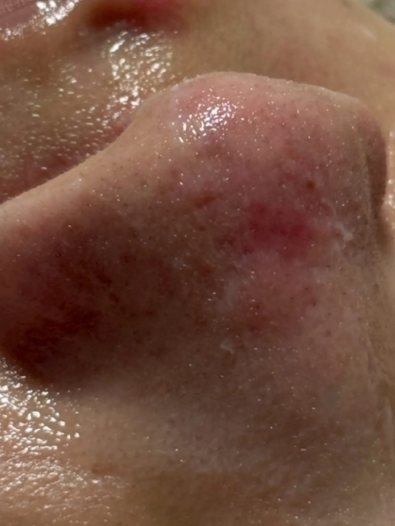 🌱毛穴の詰まり&引き締めケア🌱