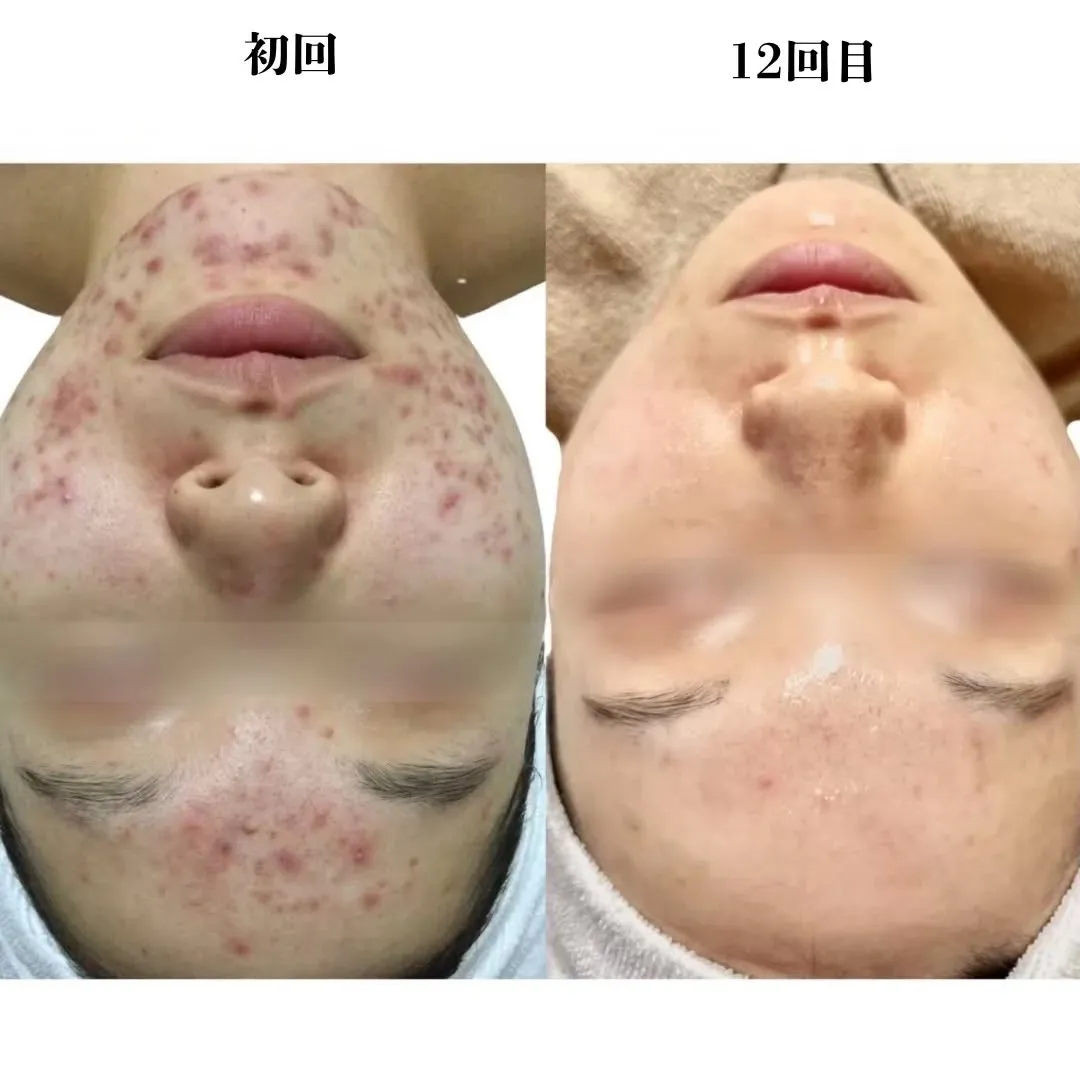 お肌を土台から整えて、ニキビができにくい