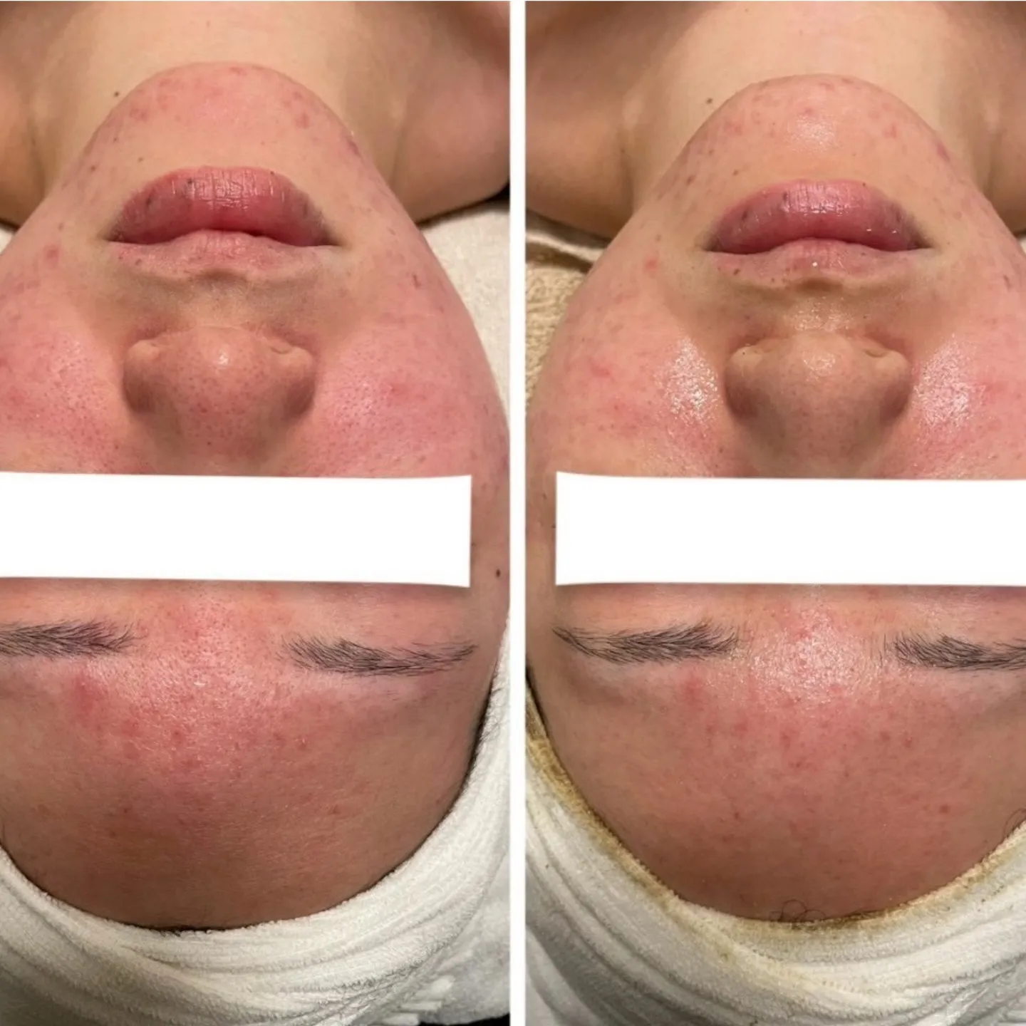 ハーブピーリング1回🌿