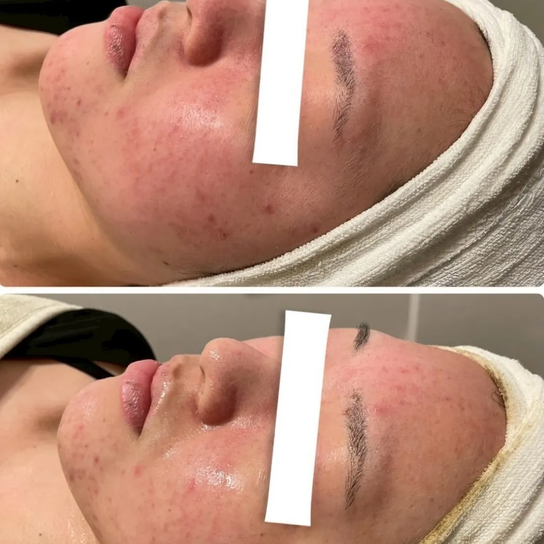 ハーブピーリング1回🌿