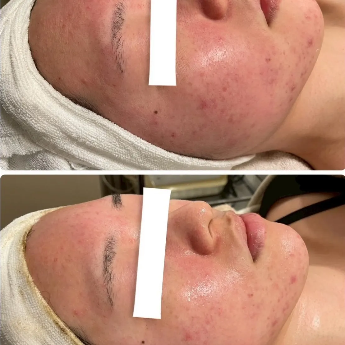 ハーブピーリング1回🌿