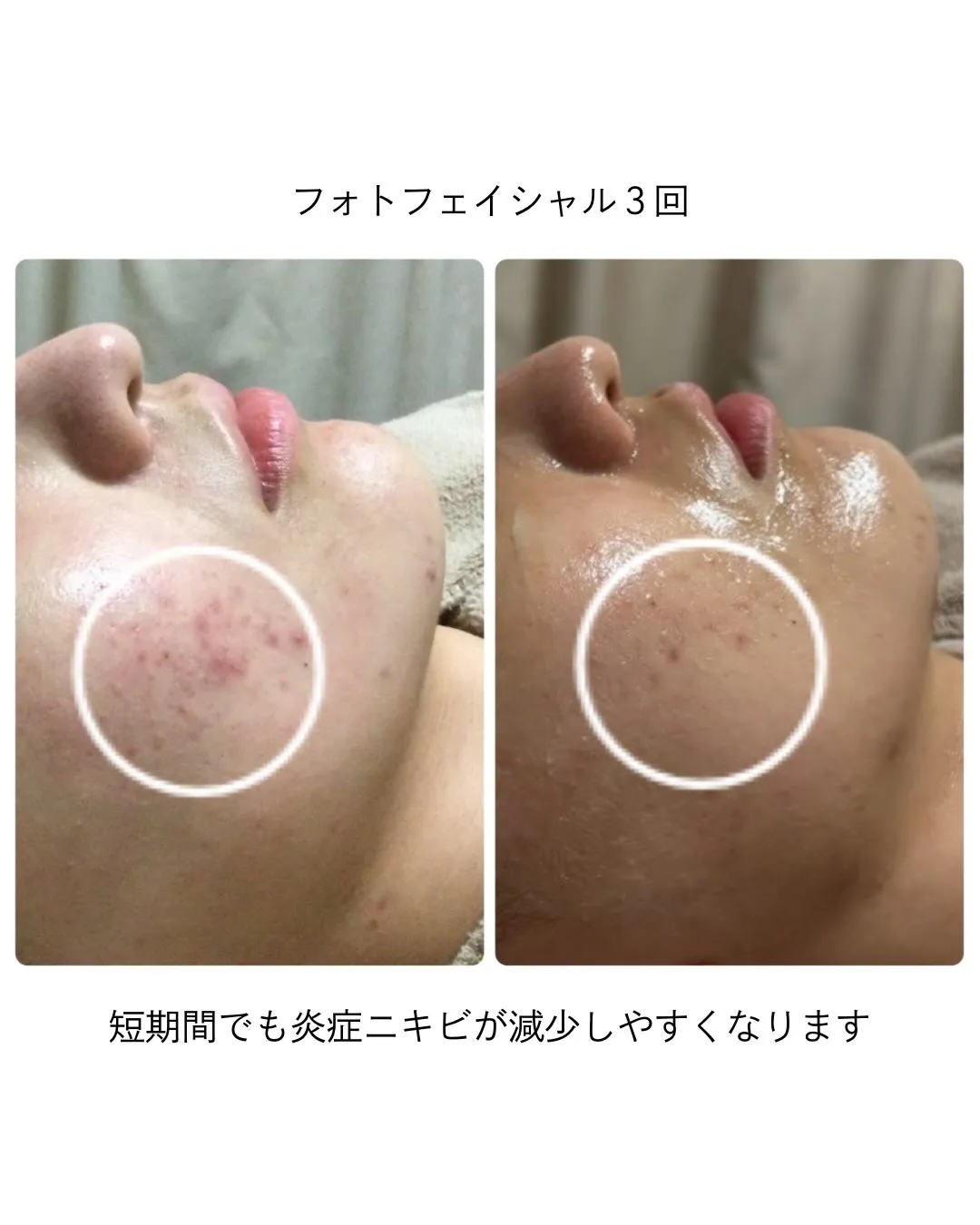 💡フォトフェイシャルでトーンアップ💡