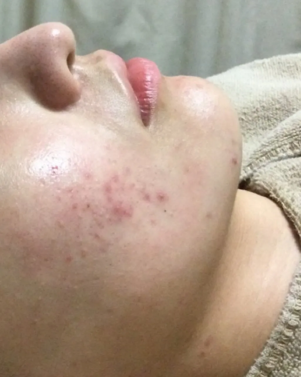 💡フォトフェイシャルでトーンアップ💡