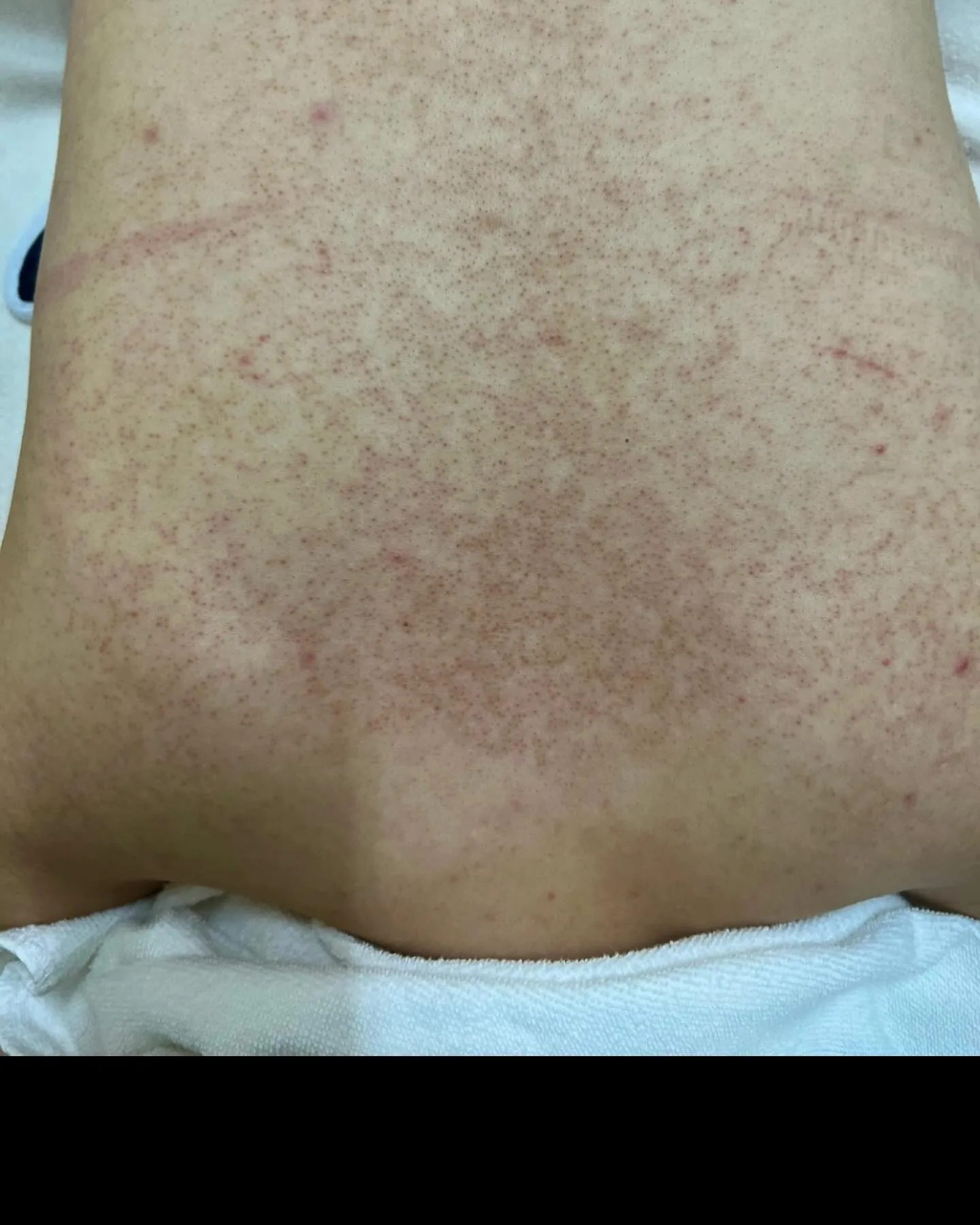 毛孔性苔癬でお悩みだった背中がここまで変化✨