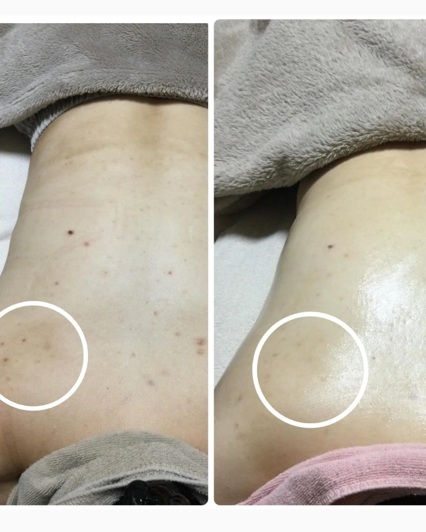 🌻今年の夏こそ美肌背中へ🌻