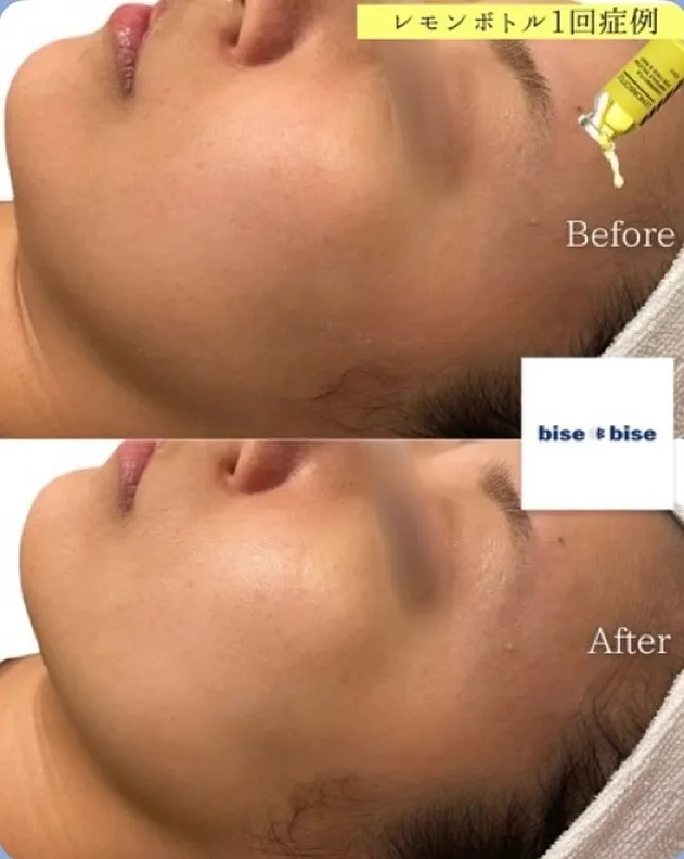 施術後のポイント