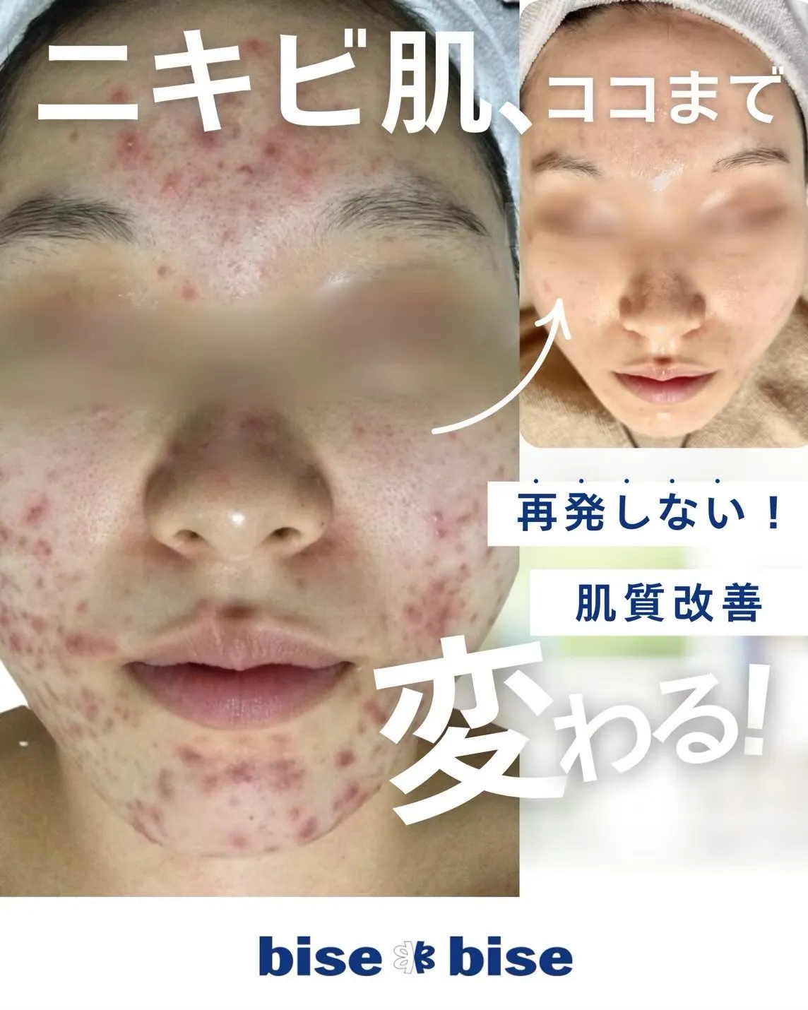 【ニキビ肌、ここまで変わる】