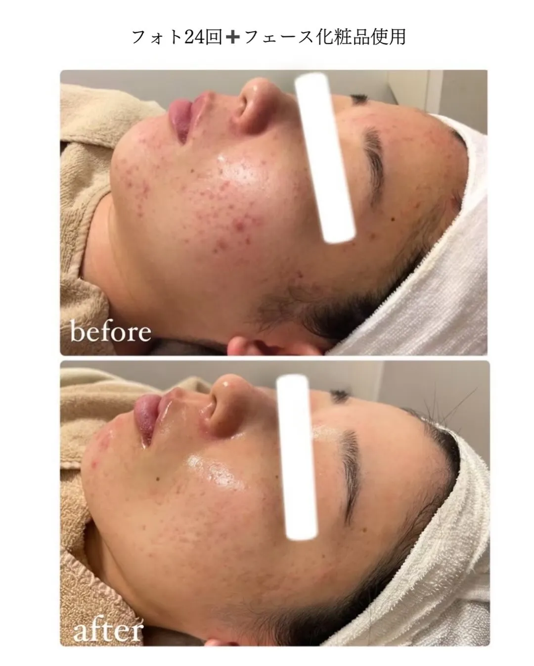 これからの季節の変わり目や花粉により肌荒れがしやすくなります...