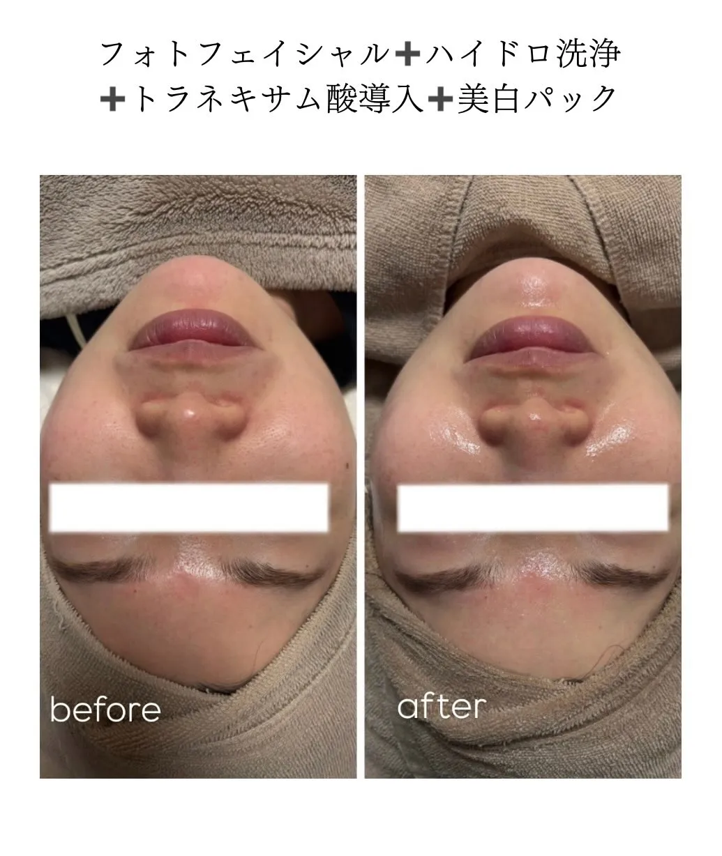 当店ではニキビ毛穴ケアはもちろん!!