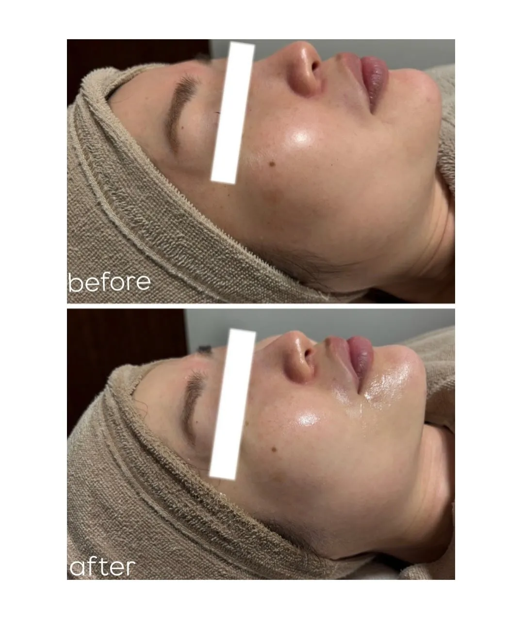 当店ではニキビ毛穴ケアはもちろん！！