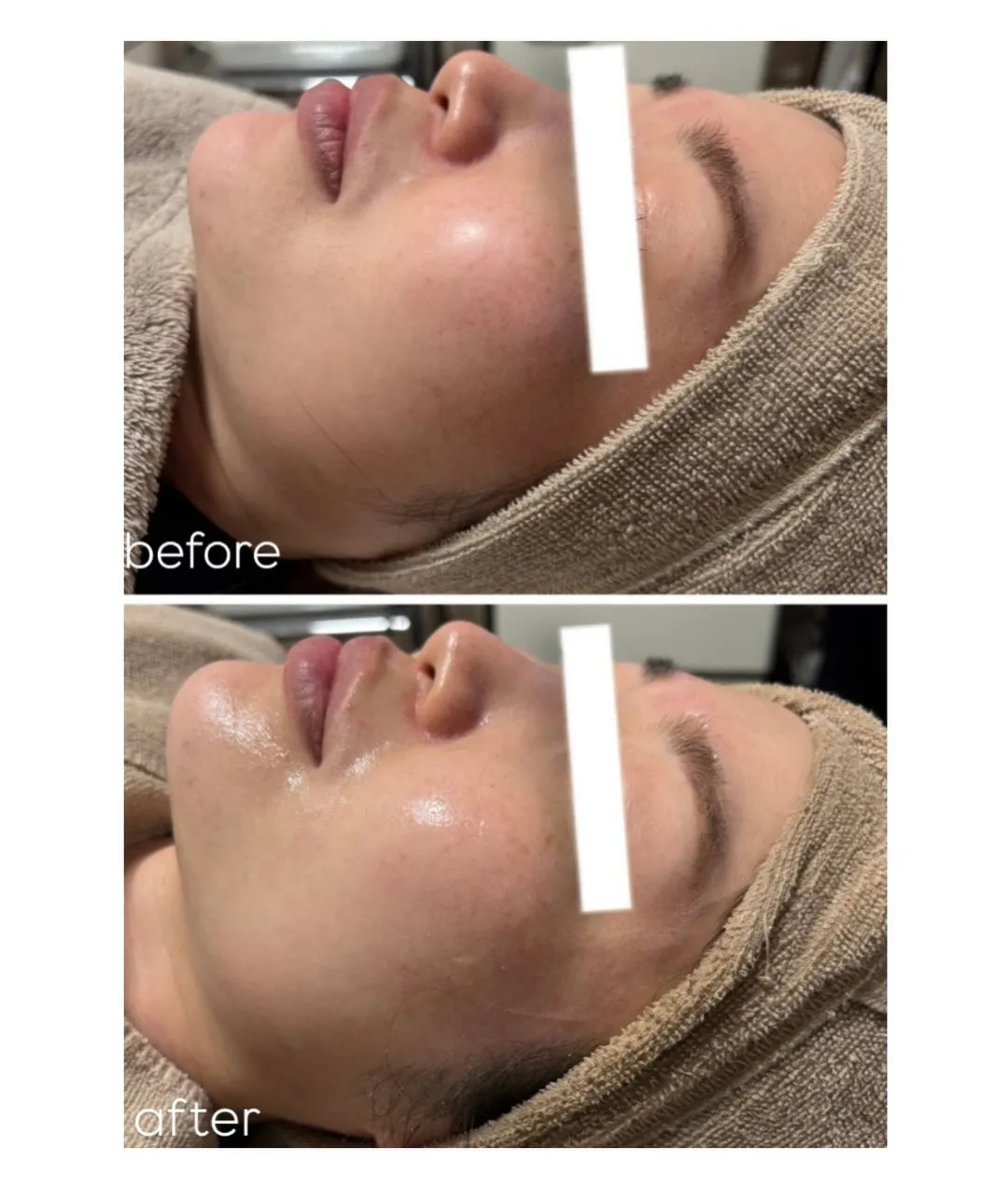 当店ではニキビ毛穴ケアはもちろん！！