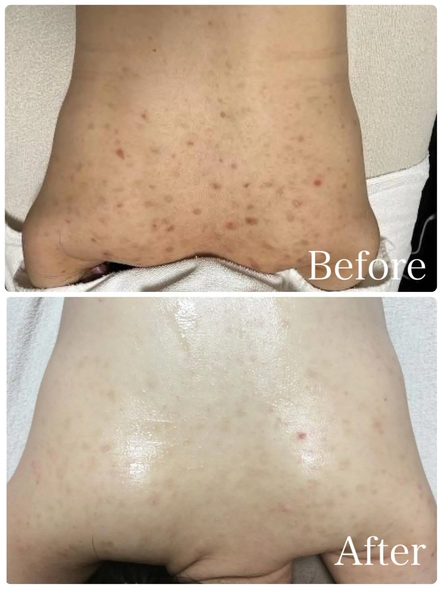 【背中フォトフェイシャル6回✨】