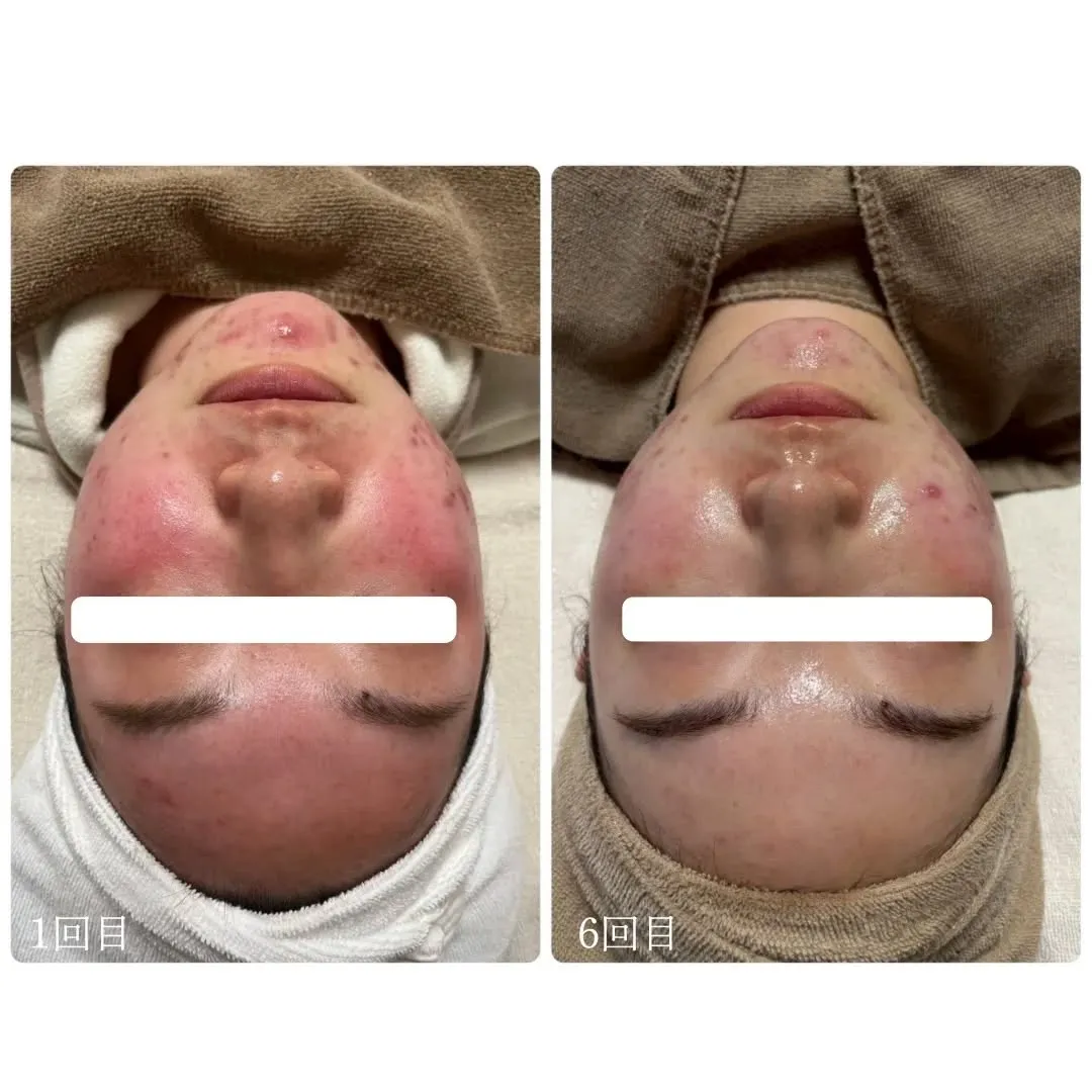 📸✨フォトフェイシャル6回目✨📸