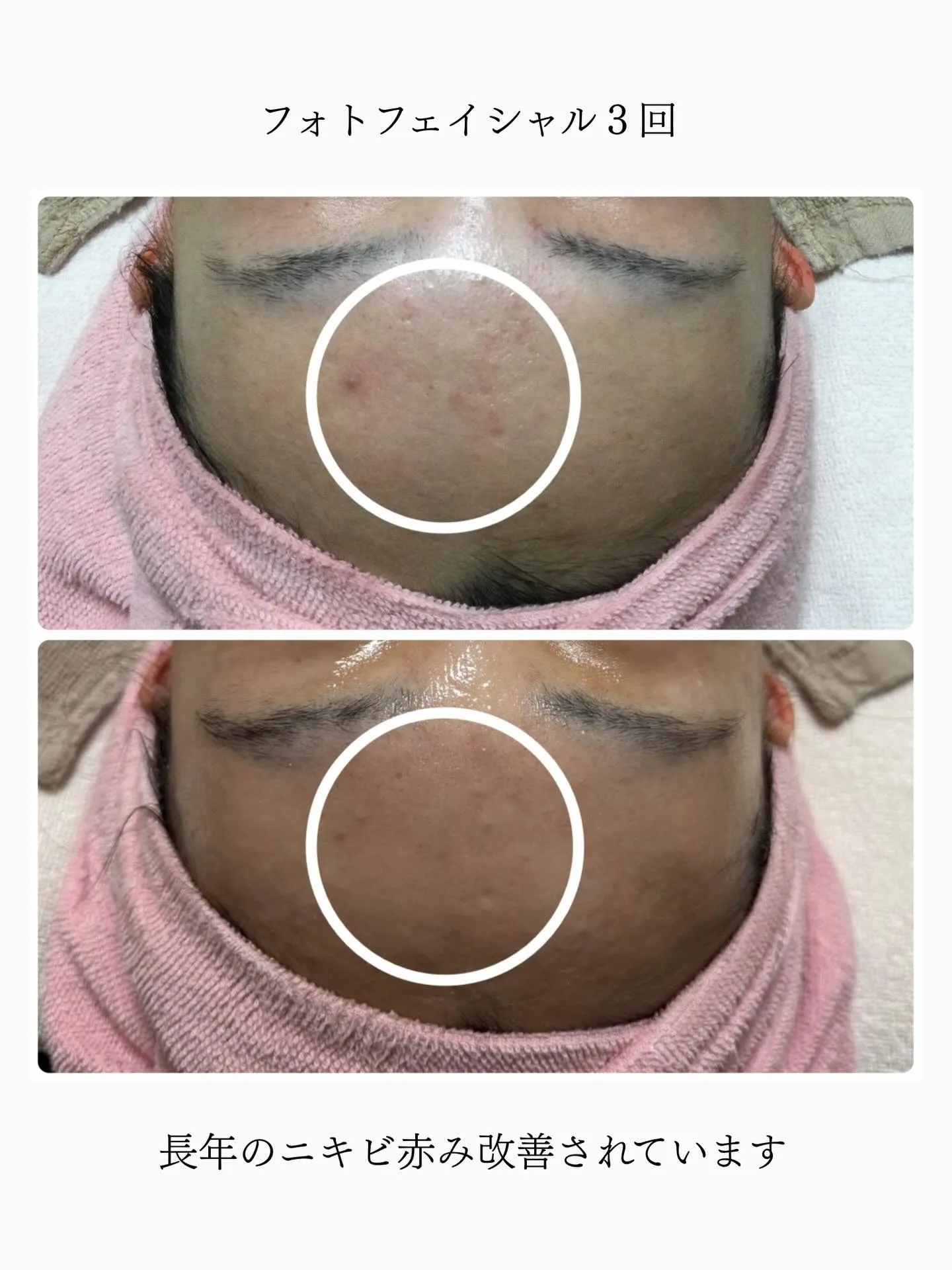 フォトフェイシャルでのBeforeAfterです🌱