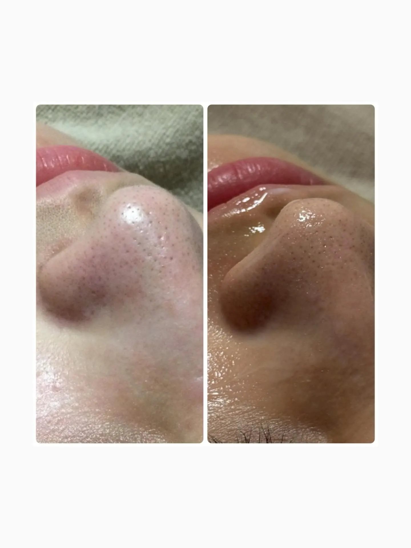 フォトフェイシャルでのBeforeAfterです🌱