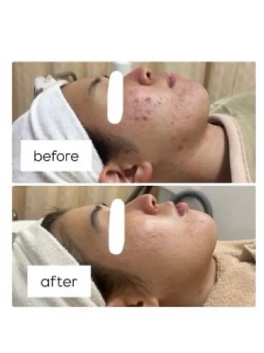 【ニキビ肌ビフォーアフター】