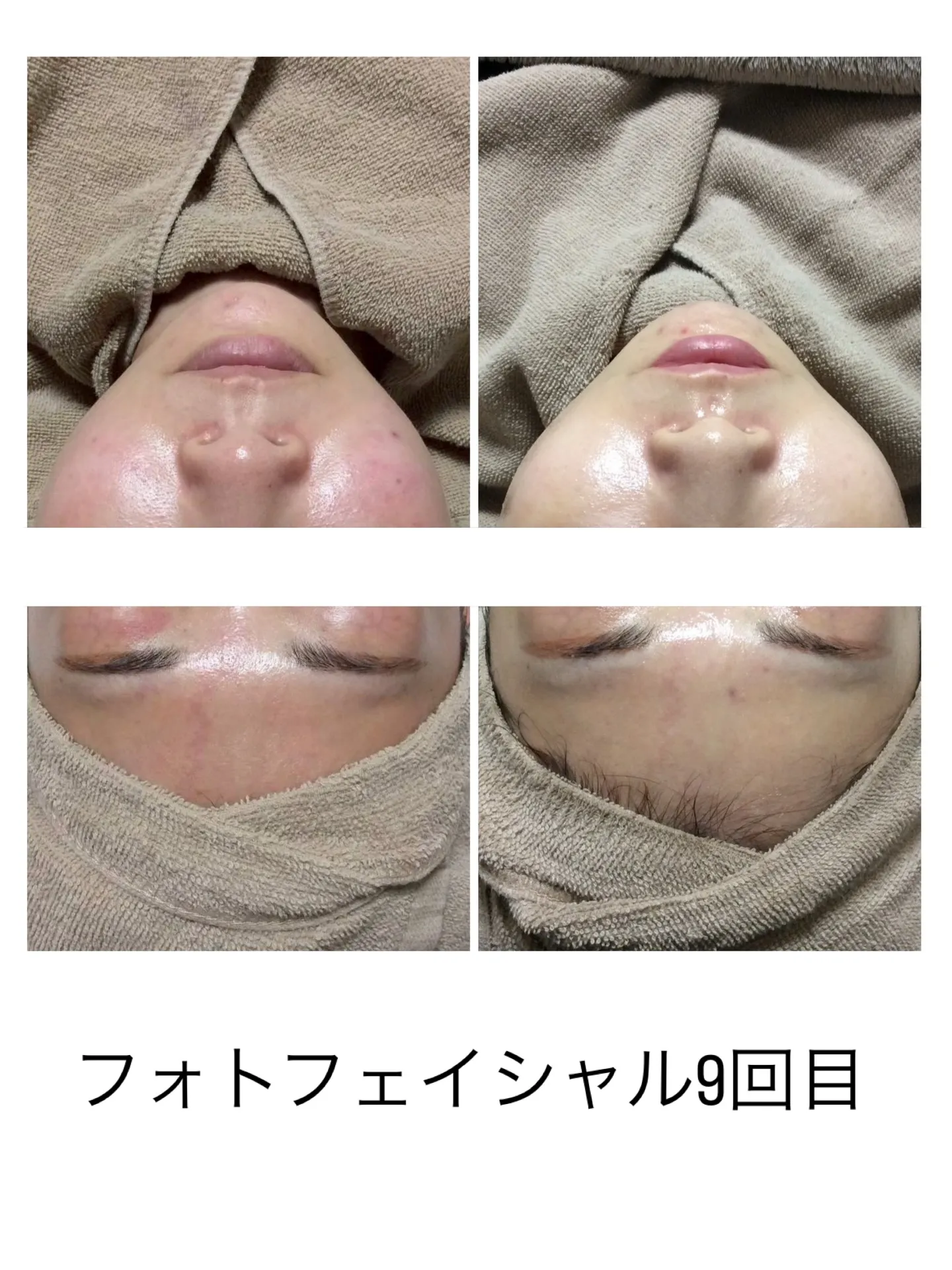 【繰り返すニキビ・毛穴で悩んでいる方へ】