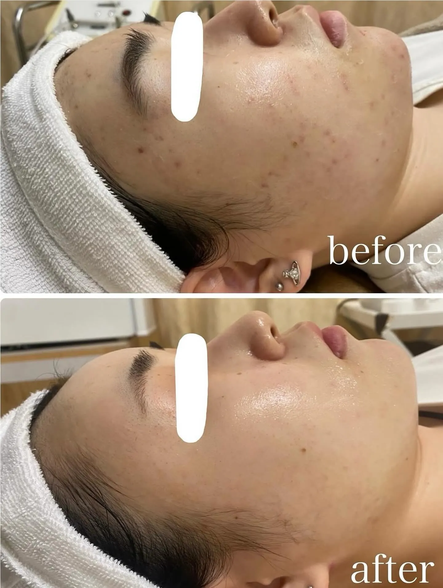 スキンケアやニキビ薬など