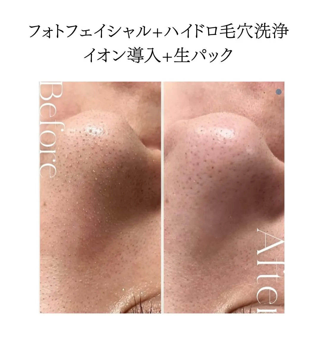 毛穴つまり黒ずみ改善❕✨