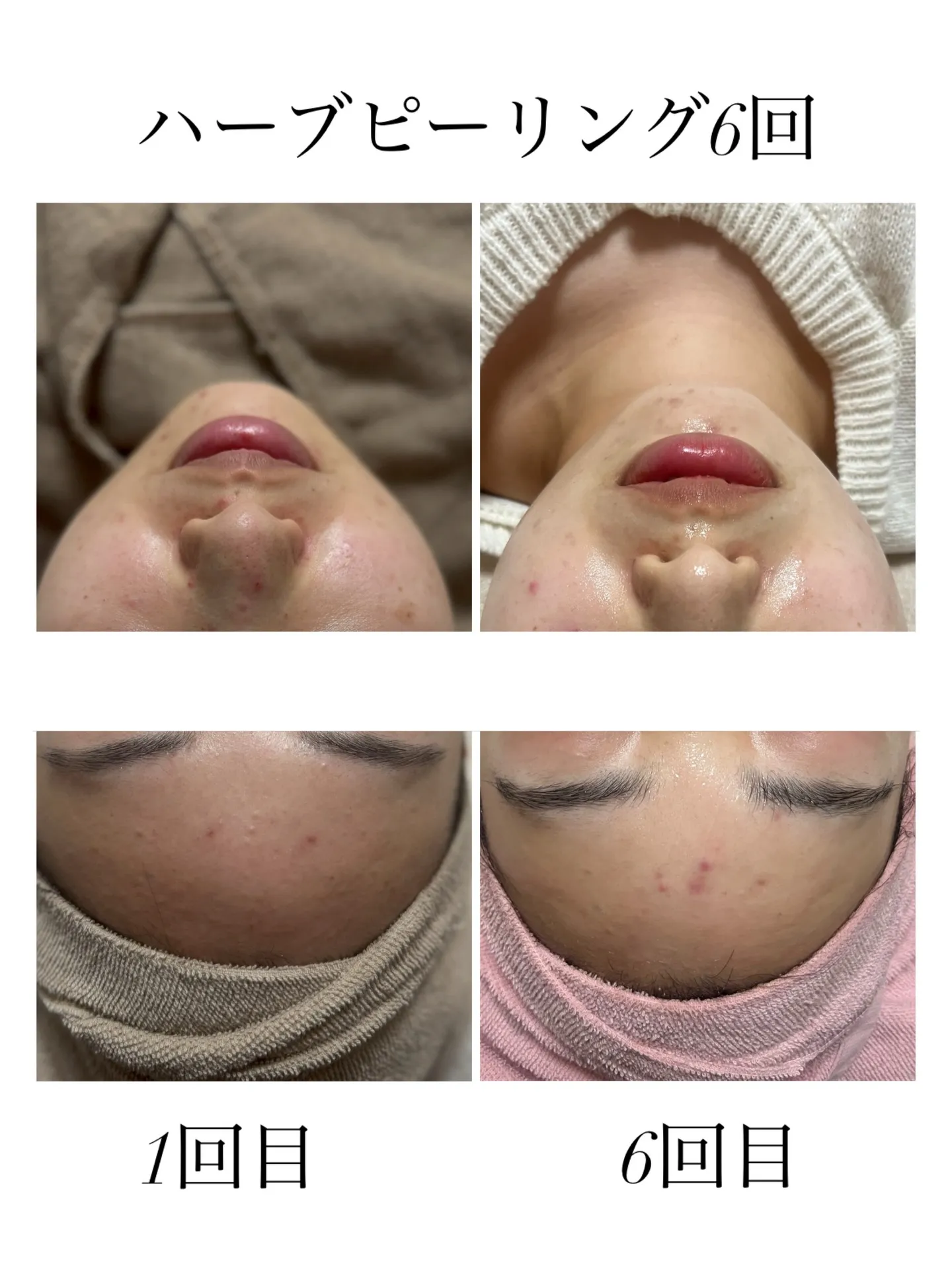 ハーブピーリング6回🌿