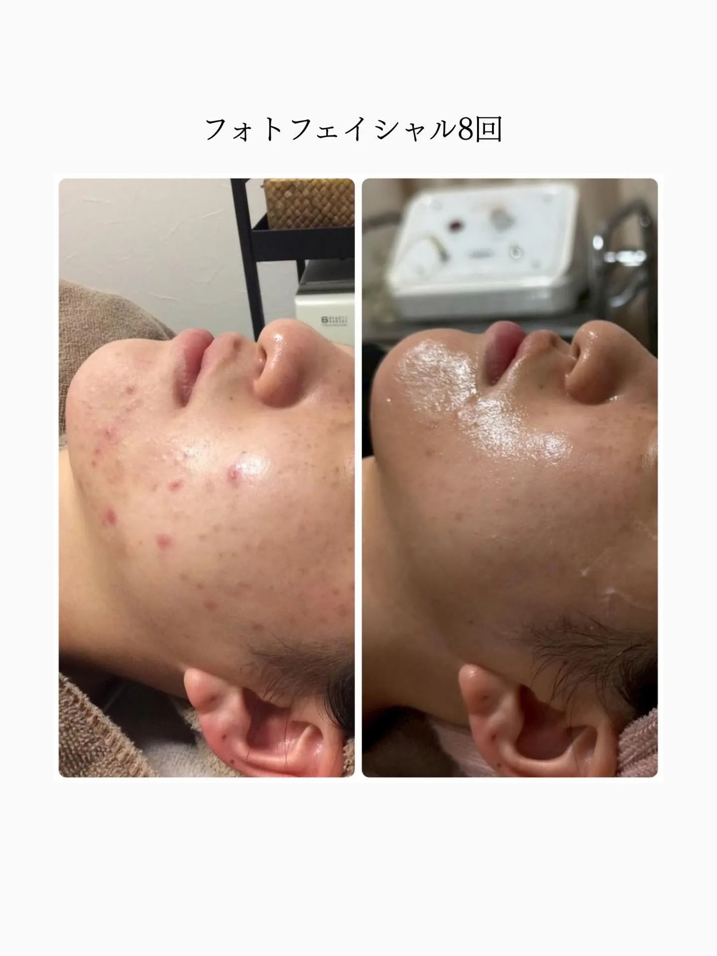🫧フォトフェイシャル8回🫧