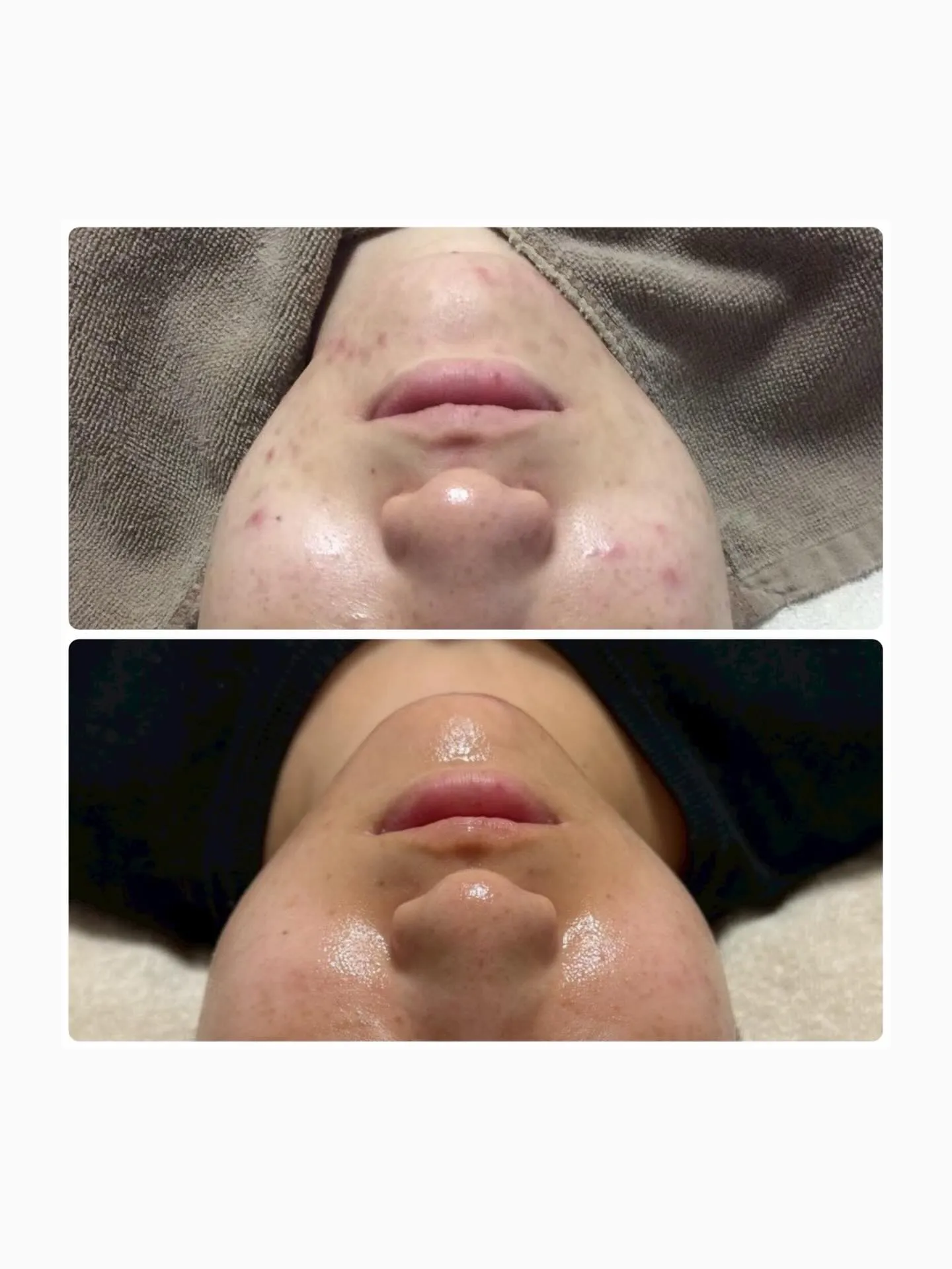 🫧フォトフェイシャル8回🫧