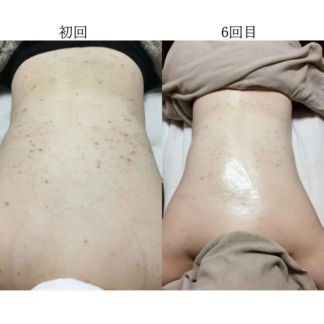背中フォト✨(6回施術)