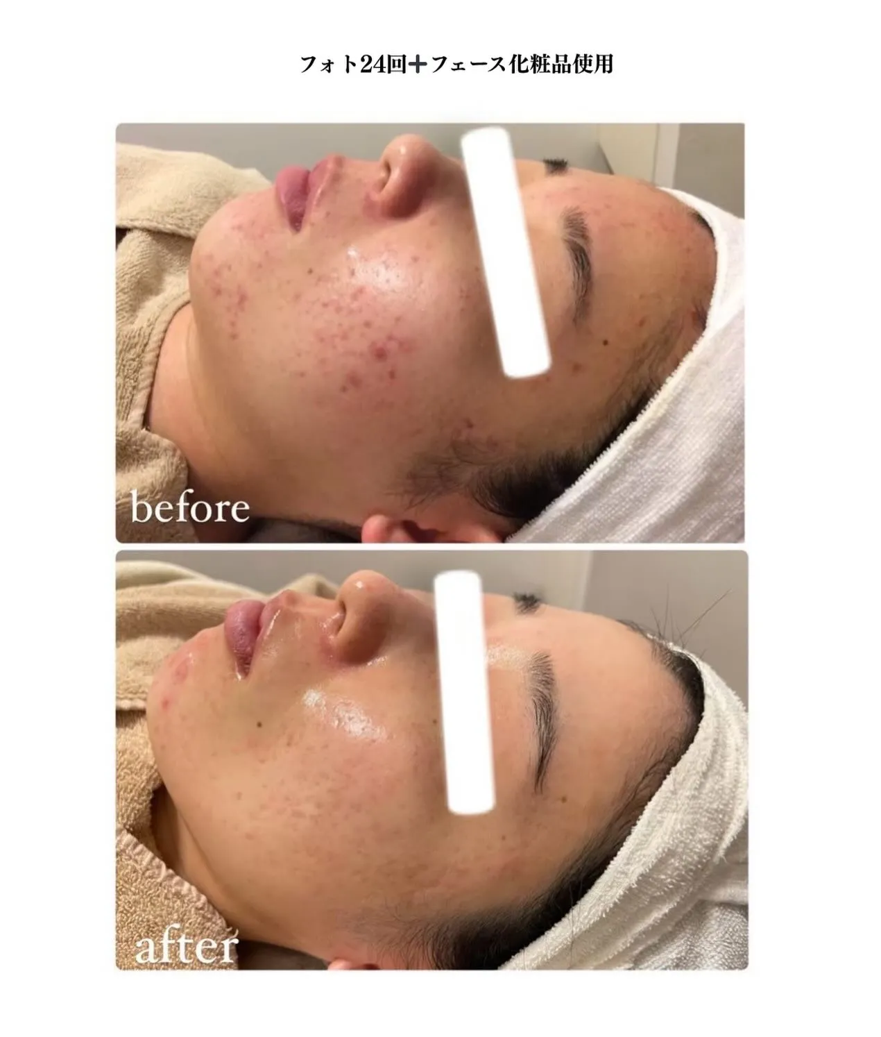 皮膚科やクリニック通いスキンケア