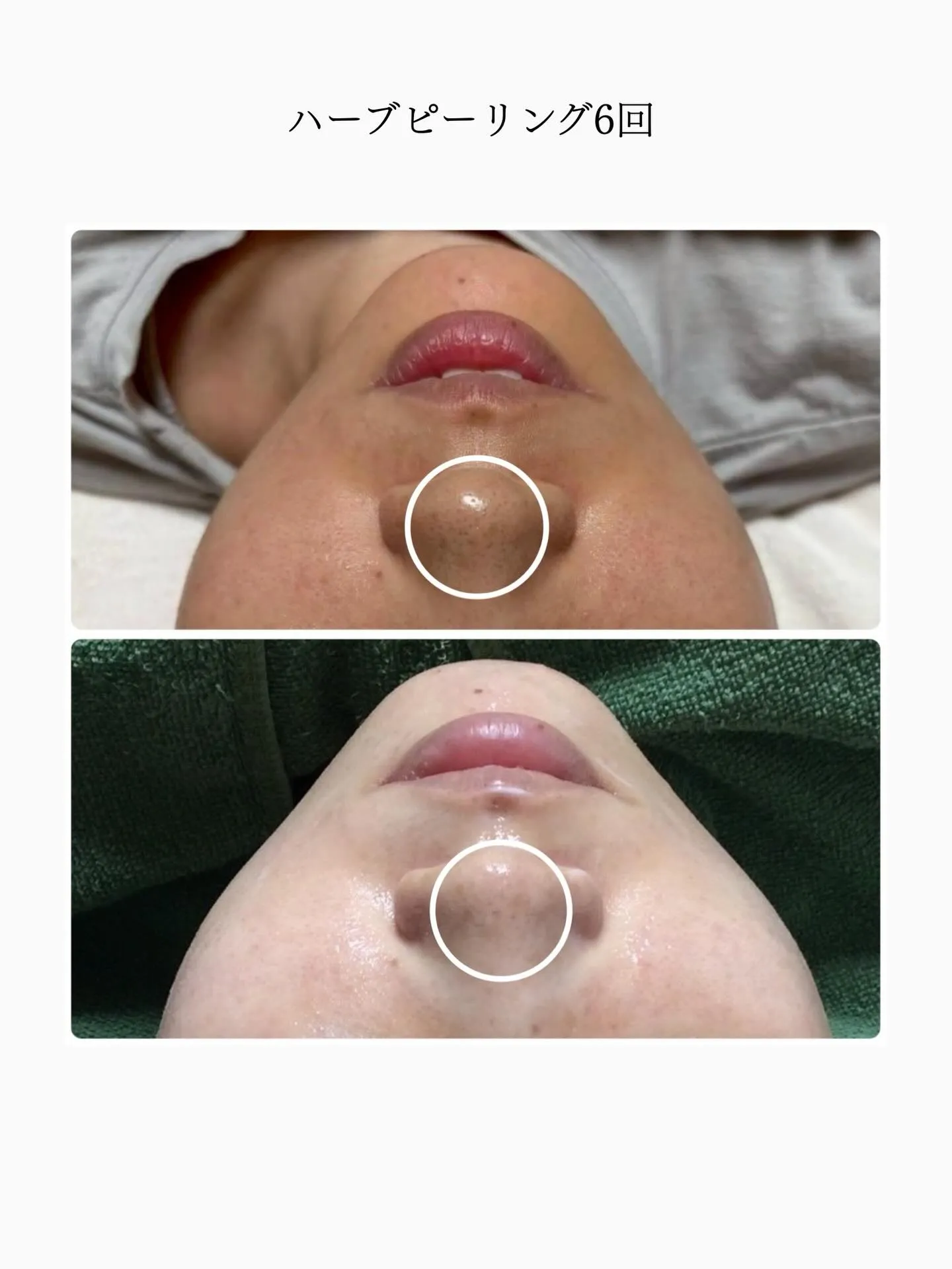 🌿ハーブピーリング6回のビフォーアフターです