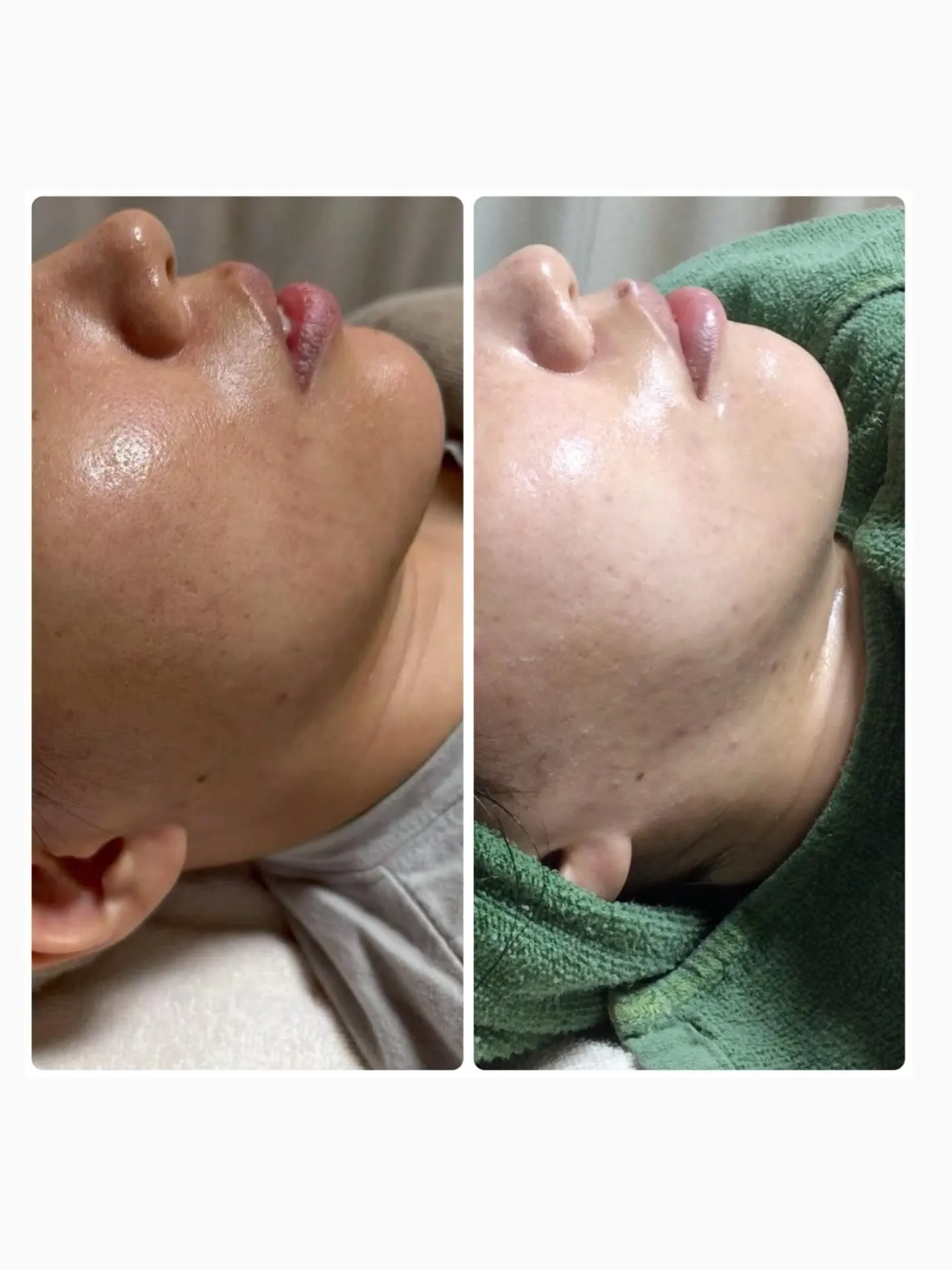 🌿ハーブピーリング6回のビフォーアフターです