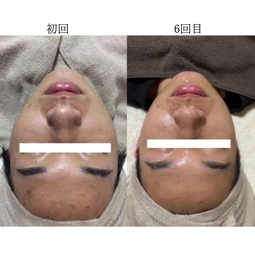 当店人気のフォトフェイシャル✨