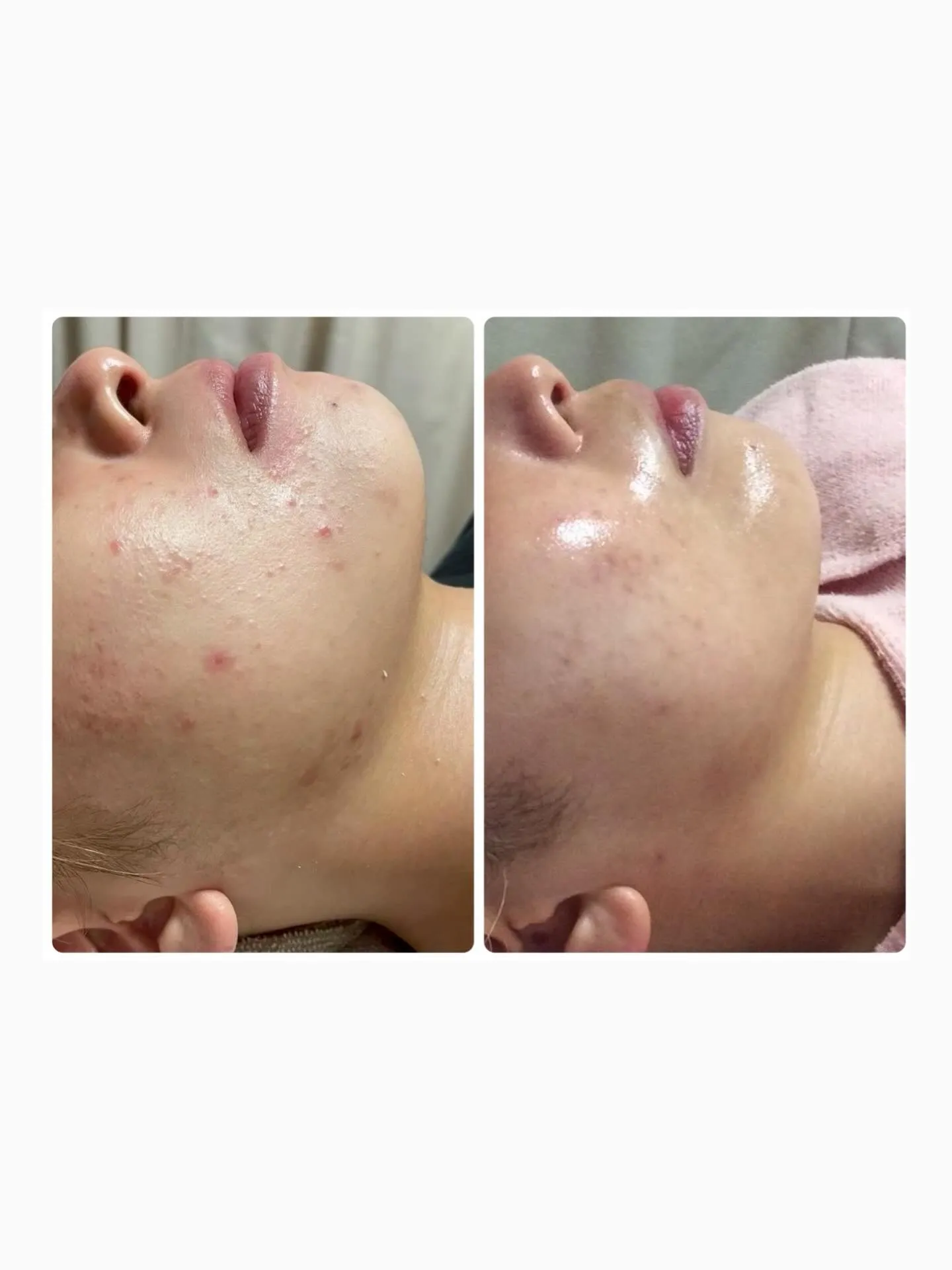 フォトフェイシャルでのBeforeAfterのお写真です🫧