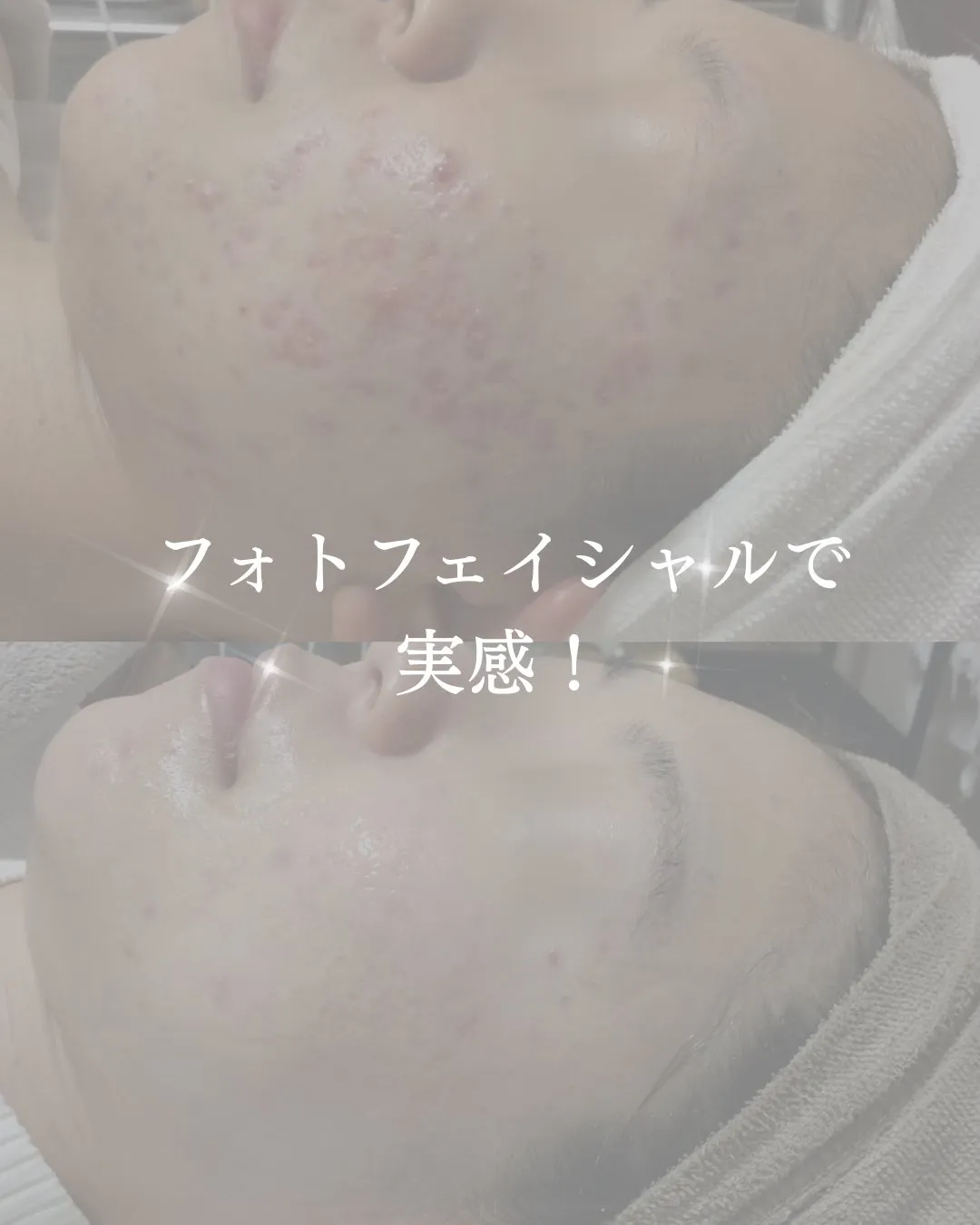 ニキビでお悩みの方必見👀！