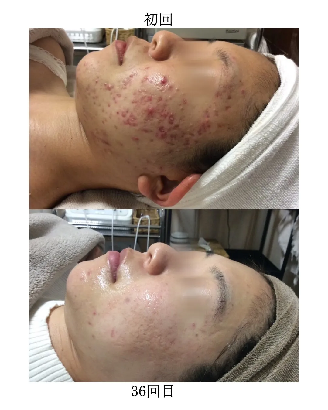 ニキビでお悩みの方必見👀！