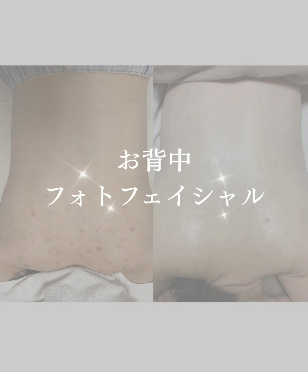 お背中フォト6回経過のお写真になります📷✨