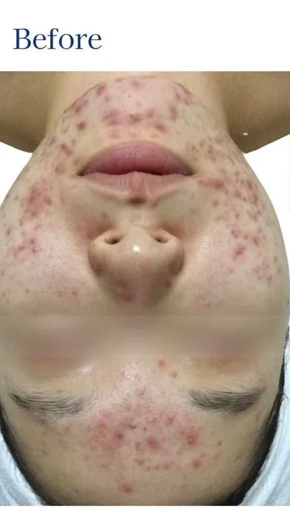 ＼肌質改善フォト経過📷✨／