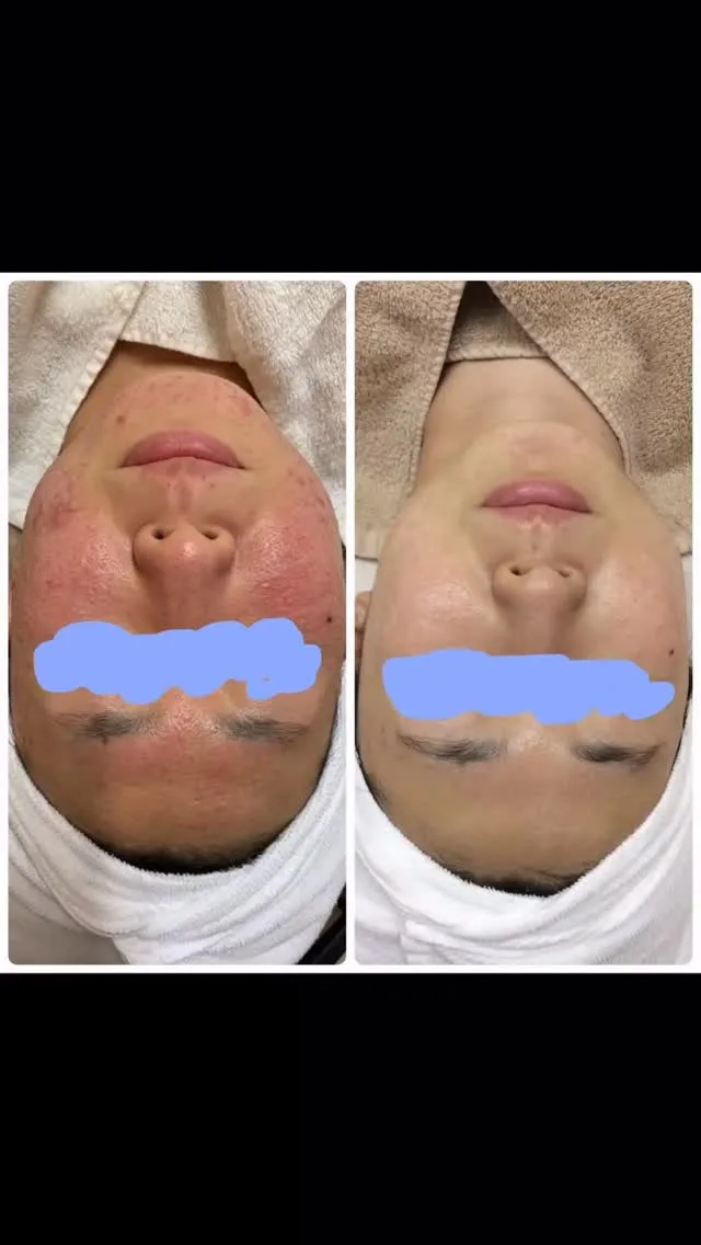 【ニキビ ビフォーアフター】