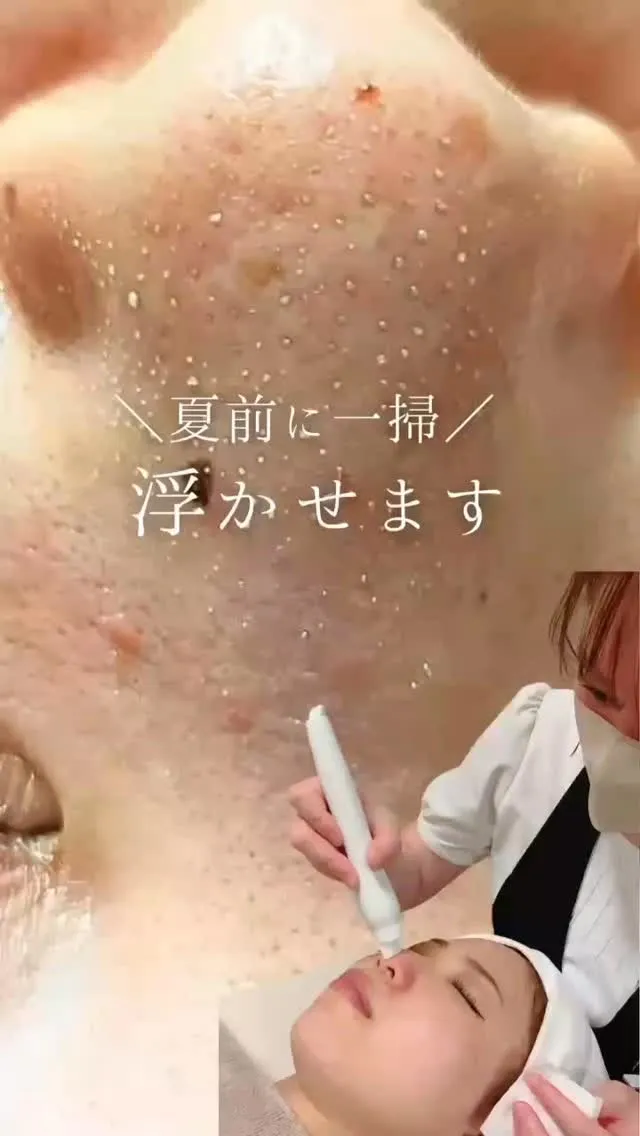 夏までにフォトフェイシャルで