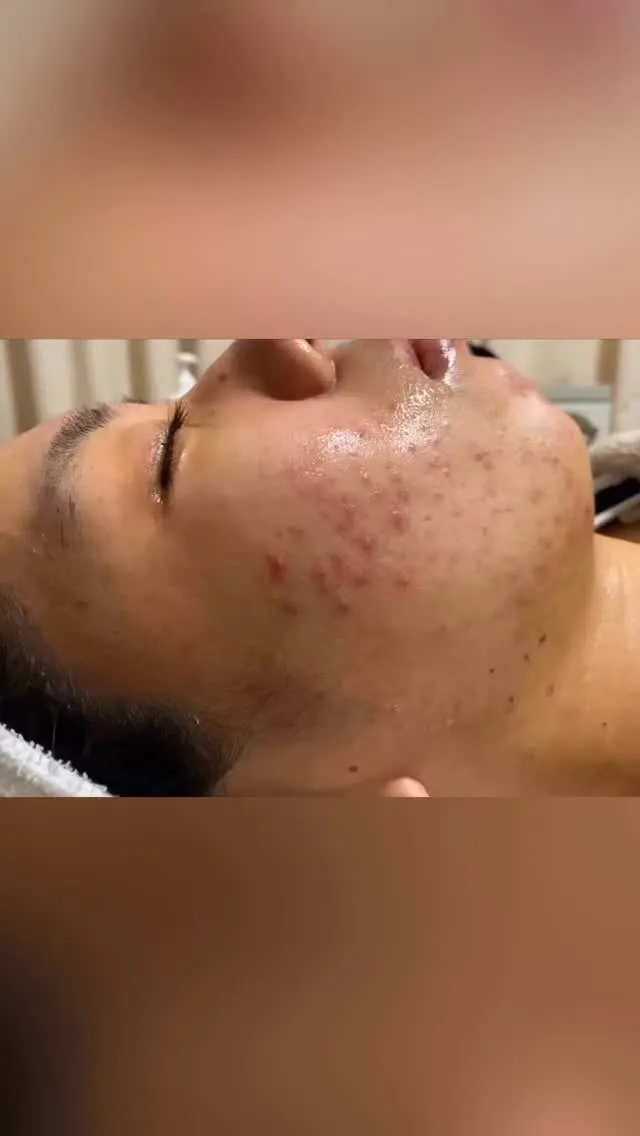 「ニキビ治したいけどエステ勇気いるな…」っと思ってませんか？