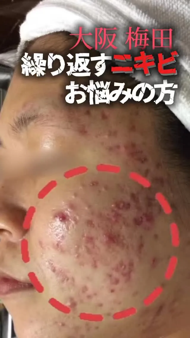 何をしても繰り返すニキビ