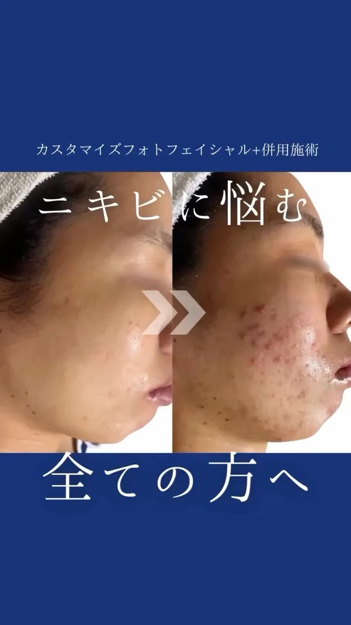 ニキビでお悩みの方ぜひ当店へお任せください✨