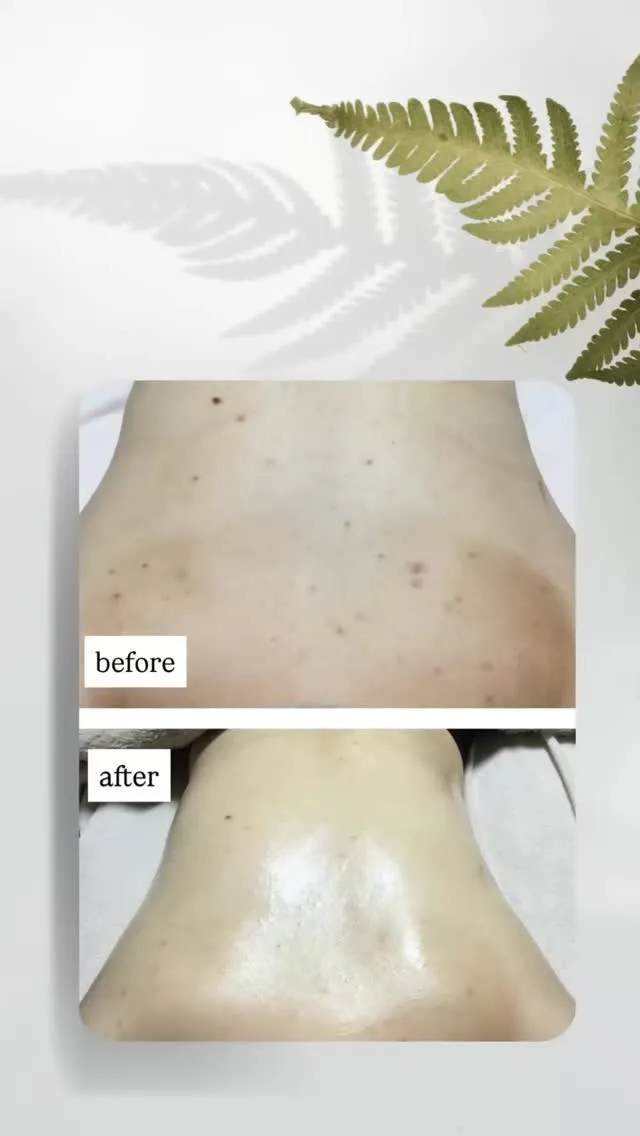 【夏に向けて背中ニキビニキビ跡本気で改善しませんか？】