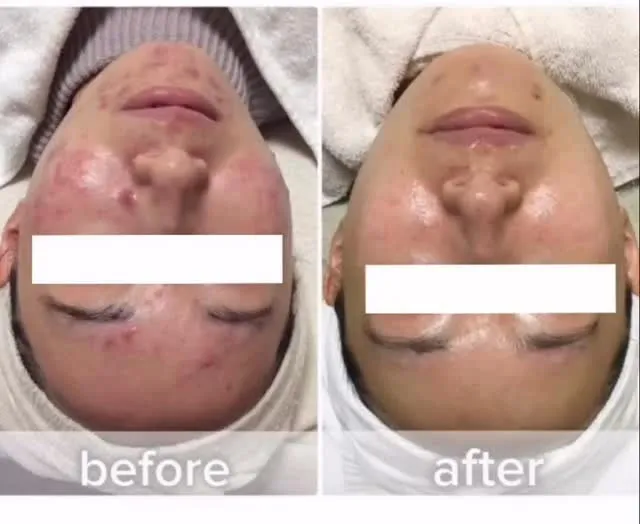 #肌管理 #大阪エステ #ニキビ #フォトフェイシャル