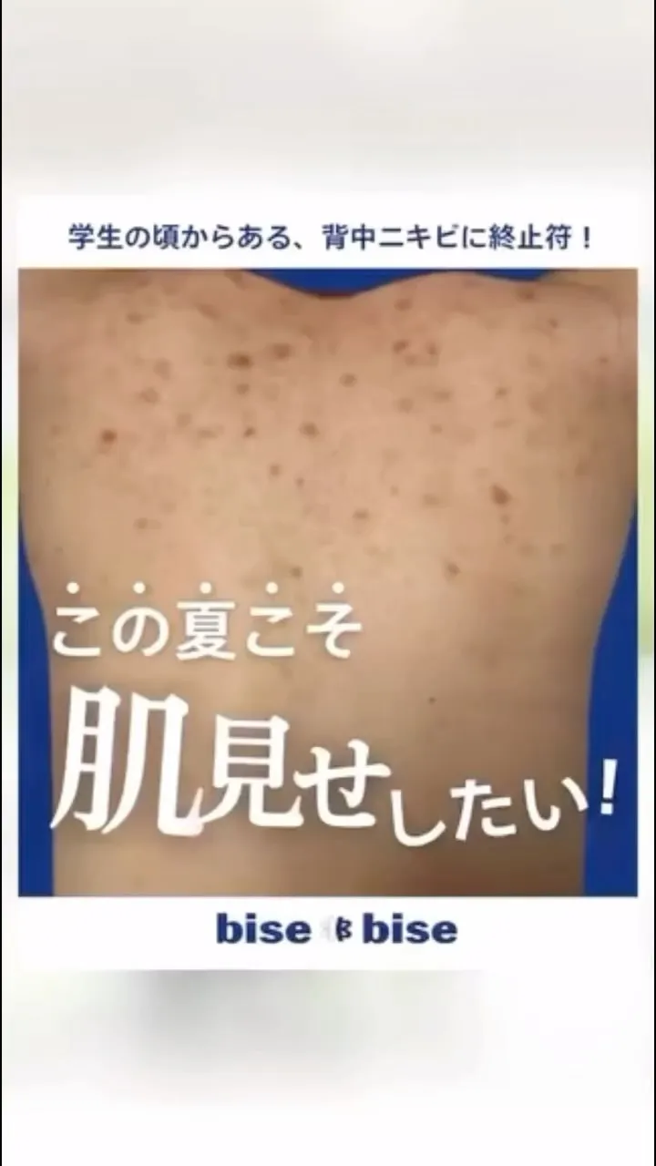 🌻夏になると背中ニキビでやすい方必見