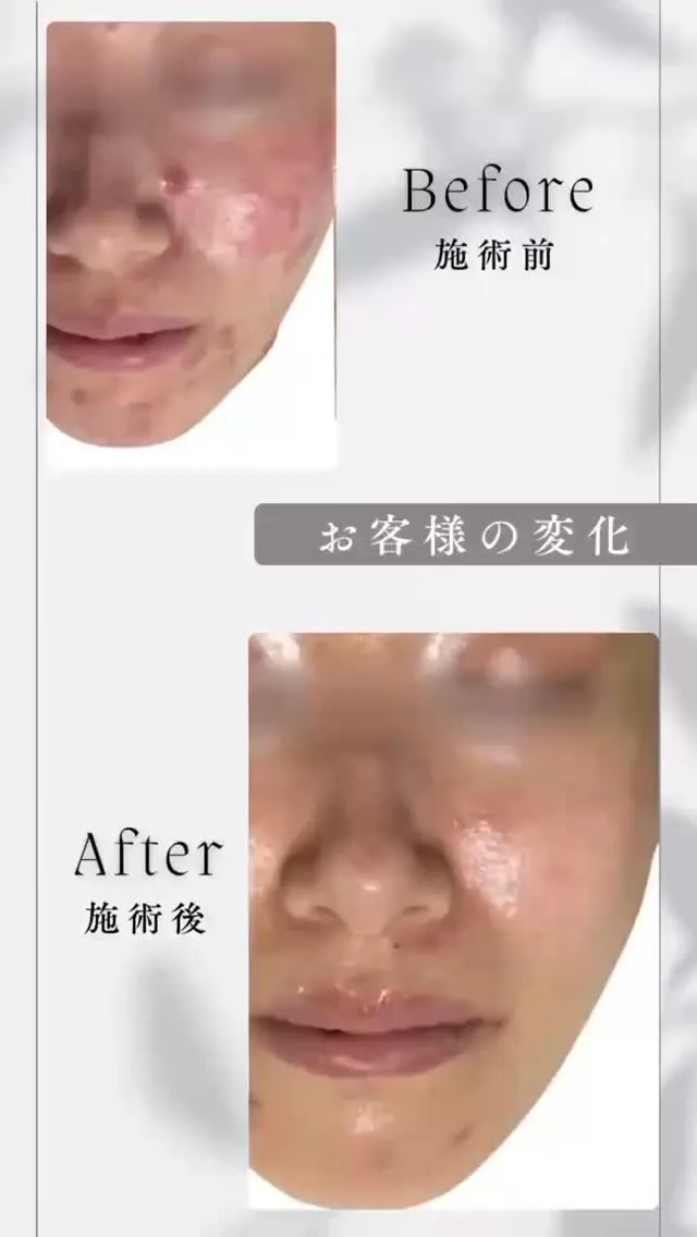 #フォトフェイシャル #肌管理