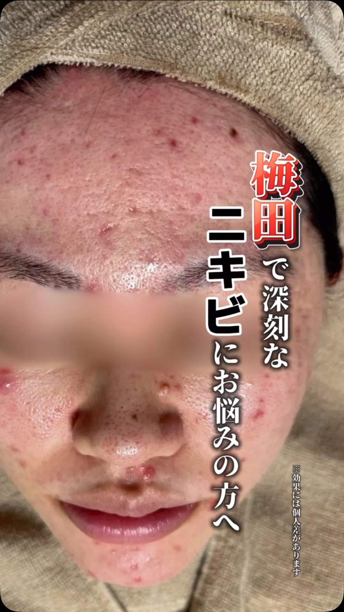 皮膚科でも治らなかったニキビ、諦めるのはまだ早いです！